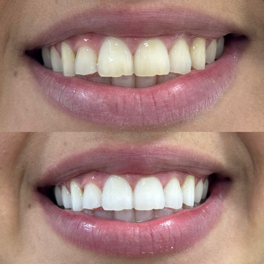 Resultado de clareamento - Realizado por: Dr. Danilo Alves - CRO 155.313