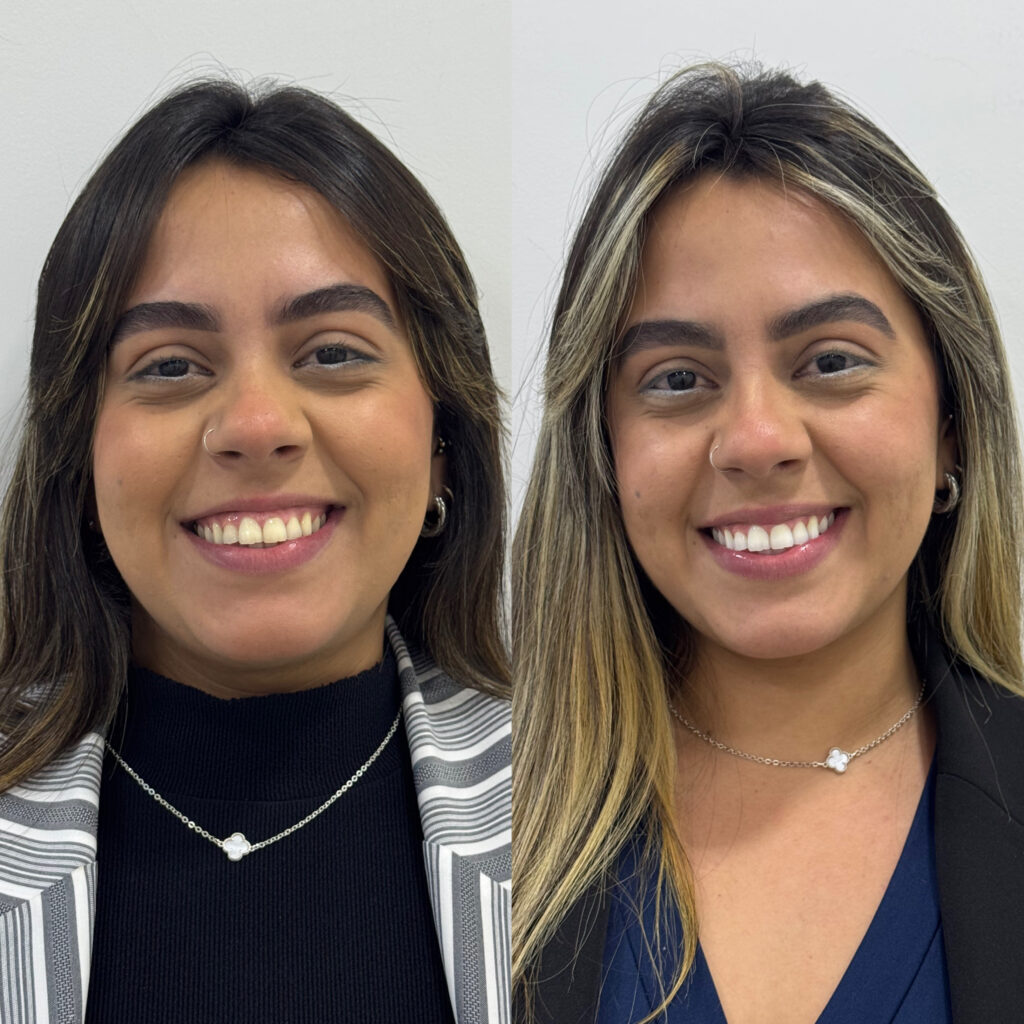 Resultado de clareamento - Realizado por: Dr. Danilo Alves - CRO 155.313