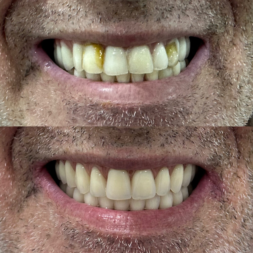 Troca de protocolo antigo por um novo - Realizado por Dra. Any Caroliny - CRO 110.078