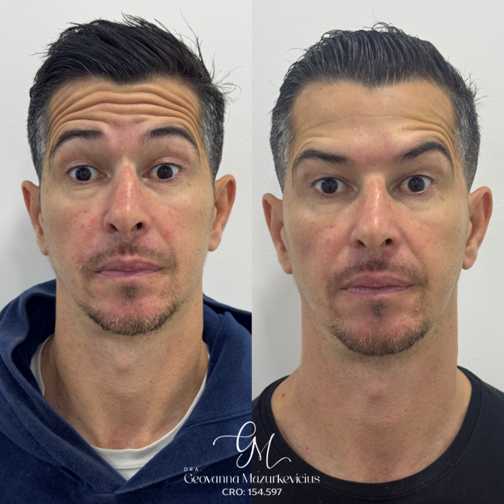 Aplicação de toxina botulínica