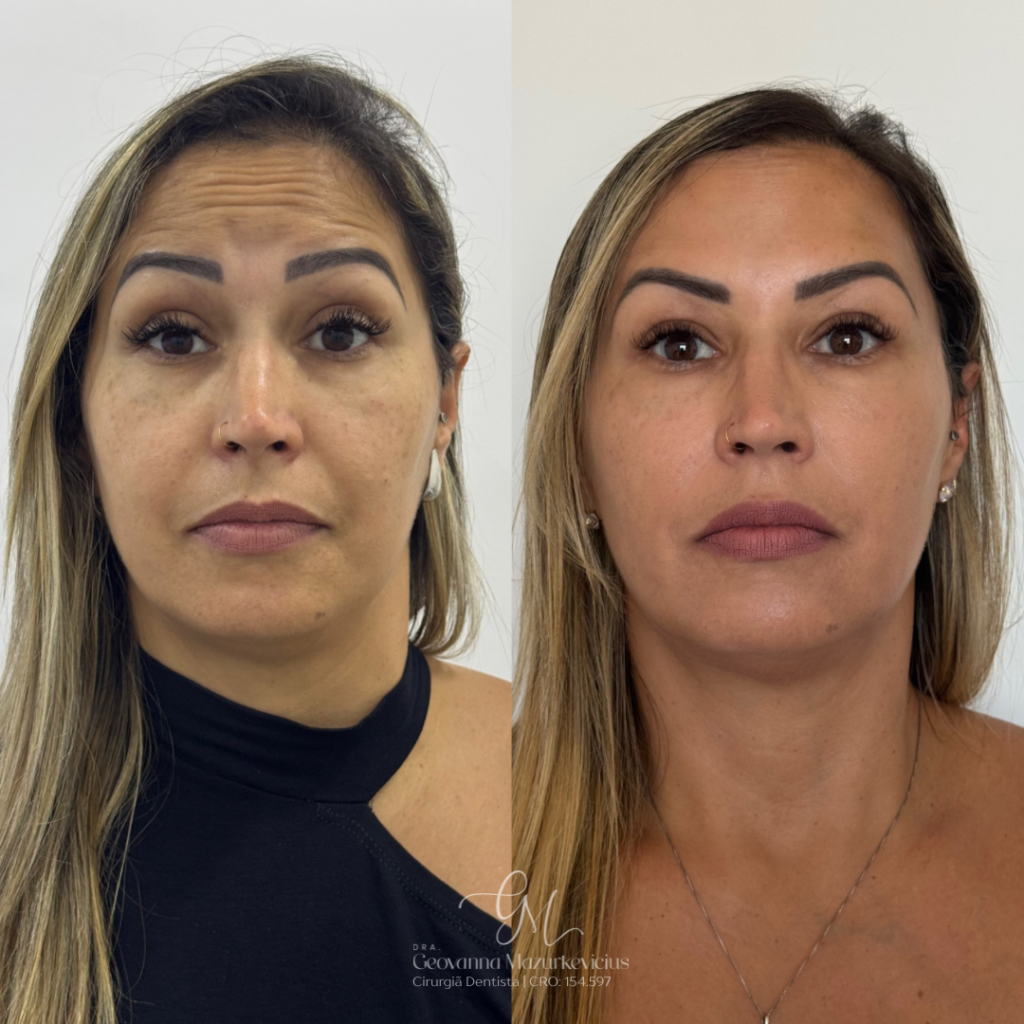 Aplicação de toxina botulínica