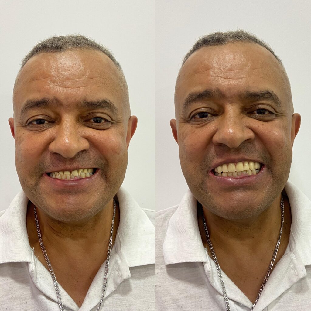 Troca de próteses antigas por novas